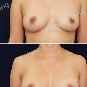 Nâng ngực Dr Ngọc Trung - ca 58