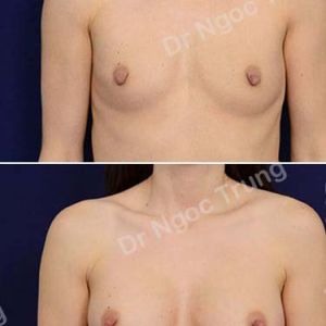 Nâng ngực Dr Ngọc Trung - ca 59