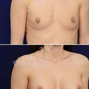 Nâng ngực Dr Ngọc Trung - ca 59