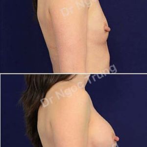 Nâng ngực Dr Ngọc Trung - ca 59