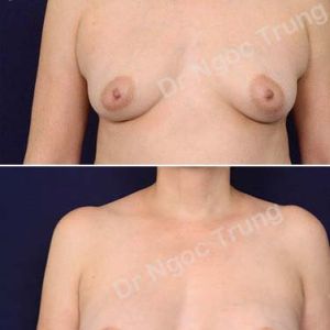 Nâng ngực Dr Ngọc Trung - ca 62