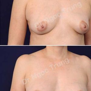 Nâng ngực Dr Ngọc Trung - ca 62
