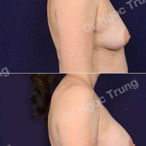 Nâng ngực Dr Ngọc Trung - ca 62