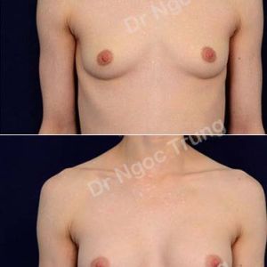 Nâng ngực Dr Ngọc Trung - ca 63