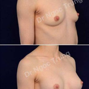 Nâng ngực Dr Ngọc Trung - ca 63