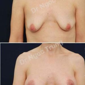 Nâng ngực Dr Ngọc Trung - ca 64