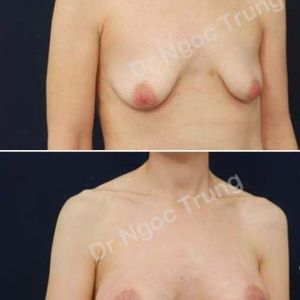 Nâng ngực Dr Ngọc Trung - ca 64