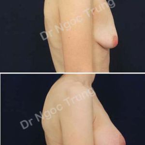 Nâng ngực Dr Ngọc Trung - ca 64