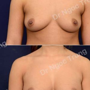 Nâng ngực Dr Ngọc Trung - ca 65