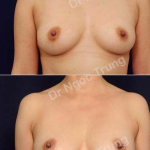Nâng ngực Dr Ngọc Trung - ca 66