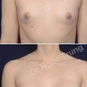 Nâng ngực Dr Ngọc Trung - ca 68