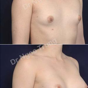 Nâng ngực Dr Ngọc Trung - ca 68