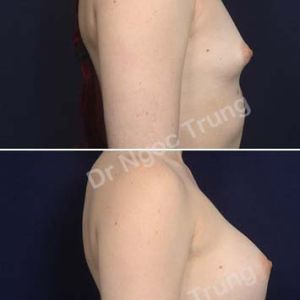 Nâng ngực Dr Ngọc Trung - ca 68