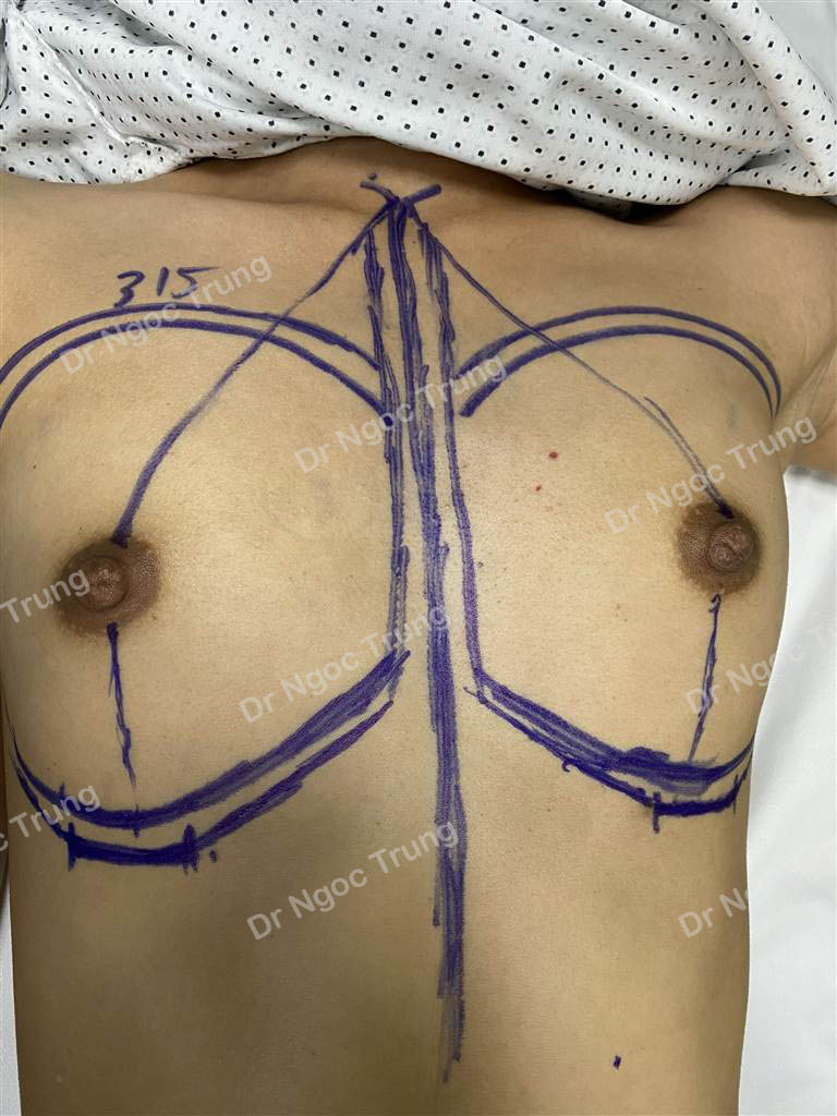 Nâng ngực đặt túi Motiva Nanochip size 315 cc, Dr Ngọc Trung - ca 69