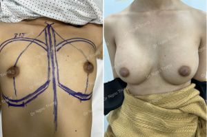 Nâng ngực đặt túi Motiva Nanochip size 315 cc, Dr Ngọc Trung - ca 69