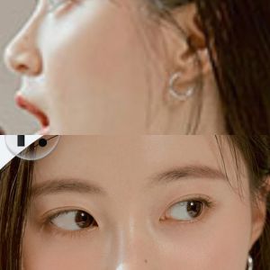 Da mũi mỏng, sống mũi rất thấp (gần như không có) thì phải nâng mũi thế nào?