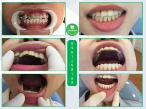 Ca niềng răng số 5062 - Nha khoa Bauman