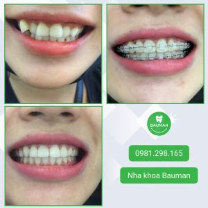Ca niềng răng số 5046 - Nha khoa Bauman