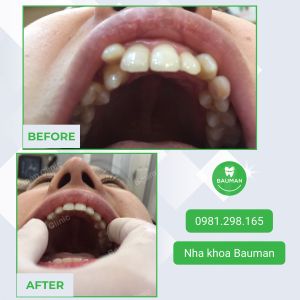 Ca niềng răng số 5049 - Nha khoa Bauman