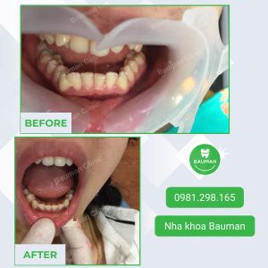 Ca niềng răng số 5049 - Nha khoa Bauman