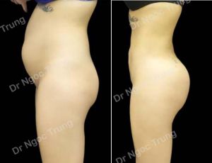 Nâng mông BBL bằng mỡ tự thân Dr Ngọc Trung - ca 1