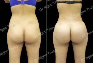 Nâng mông BBL bằng mỡ tự thân Dr Ngọc Trung - ca 1