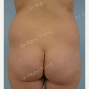 Nâng mông BBL bằng mỡ tự thân Dr Ngọc Trung - ca 2