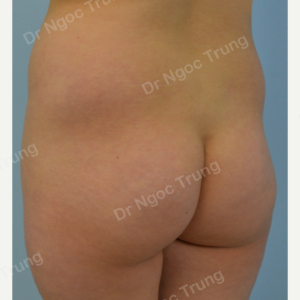 Nâng mông BBL bằng mỡ tự thân Dr Ngọc Trung - ca 2
