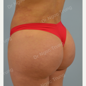 Nâng mông BBL bằng mỡ tự thân Dr Ngọc Trung - ca 2