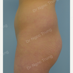 Nâng mông BBL bằng mỡ tự thân Dr Ngọc Trung - ca 2