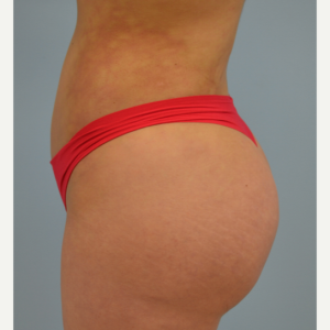 Nâng mông BBL bằng mỡ tự thân Dr Ngọc Trung - ca 2