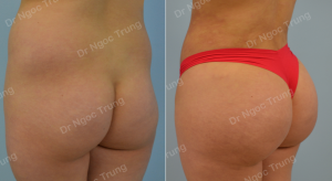 Nâng mông BBL bằng mỡ tự thân Dr Ngọc Trung - ca 2