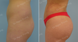 Nâng mông BBL bằng mỡ tự thân Dr Ngọc Trung - ca 2