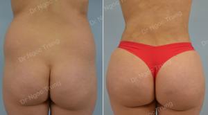 Nâng mông BBL bằng mỡ tự thân Dr Ngọc Trung - ca 2