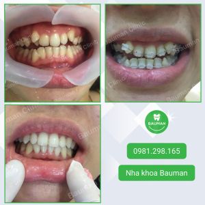Ca niềng răng số 5049 - Nha khoa Bauman