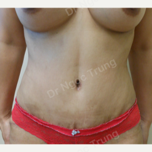 Tạo hình thành bụng nữ 40 tuổi, Dr Ngọc Trung - ca 11