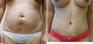 Tạo hình thành bụng nữ 40 tuổi, Dr Ngọc Trung - ca 11