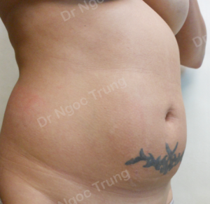 Tạo hình thành bụng nữ 41 tuổi, Dr Ngọc Trung - ca 12