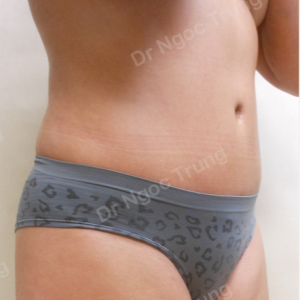 Tạo hình thành bụng nữ 41 tuổi, Dr Ngọc Trung - ca 12