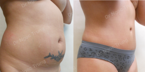 Tạo hình thành bụng nữ 41 tuổi, Dr Ngọc Trung - ca 12