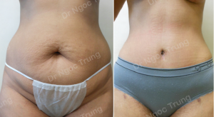 Tạo hình thành bụng, nữ 34 tuổi, Dr Ngọc Trung - ca 13