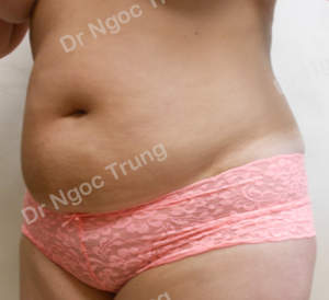 Tạo hình thành bụng nữ 37 tuổi, Dr Ngọc Trung - ca 14