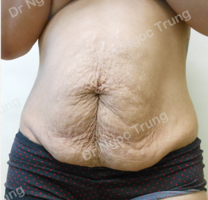 Tạo hình thành bụng nữ 35 tuổi, Dr Ngọc Trung - ca 2