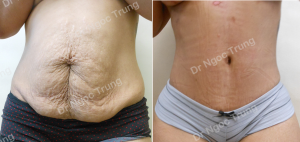 Tạo hình thành bụng nữ 35 tuổi, Dr Ngọc Trung - ca 2
