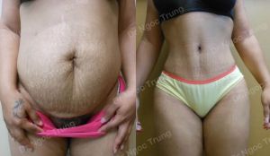 Tạo hình thành bụng Dr Ngọc Trung - ca 3