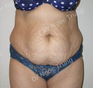 Tạo hình thành bụng nữ 38 tuổi Dr Ngọc Trung - ca 5