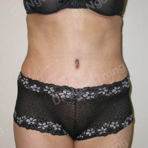 Tạo hình thành bụng nữ 38 tuổi Dr Ngọc Trung - ca 5