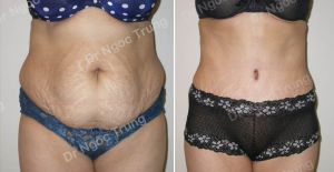 Tạo hình thành bụng nữ 38 tuổi Dr Ngọc Trung - ca 5