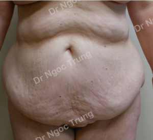 Tạo hình thành bụng nữ 47 tuổi, Dr Ngọc Trung - ca 6
