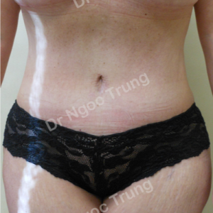 Tạo hình thành bụng nữ 47 tuổi, Dr Ngọc Trung - ca 6